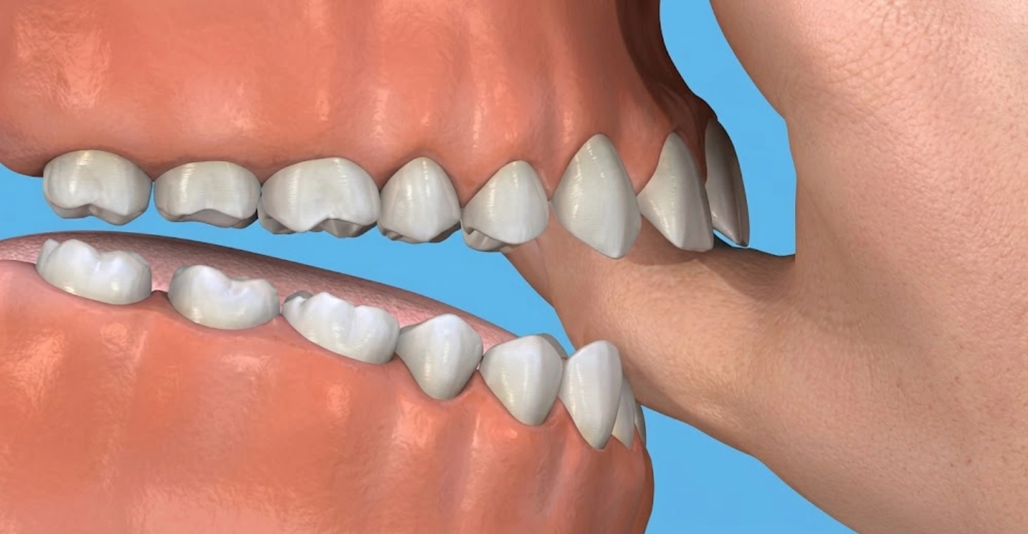 thumb sucking teeth 2